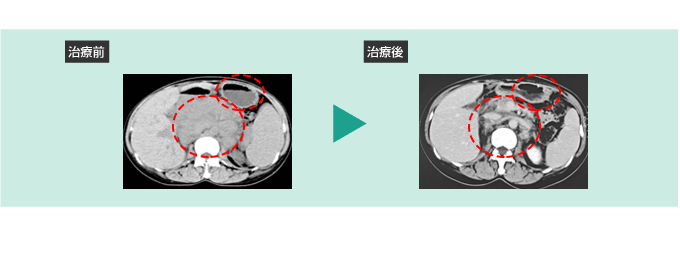 治療前：腫瘍と消化管の閉塞、治療後：腫瘍喪失と消化管機能の正常化